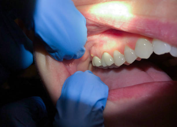 Best Emergency Dental Care for Sports Injuries in Giddings, TX